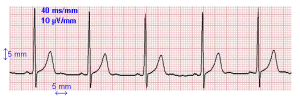 ECG